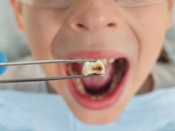 Tooth Infection Emergency Dentist in FL